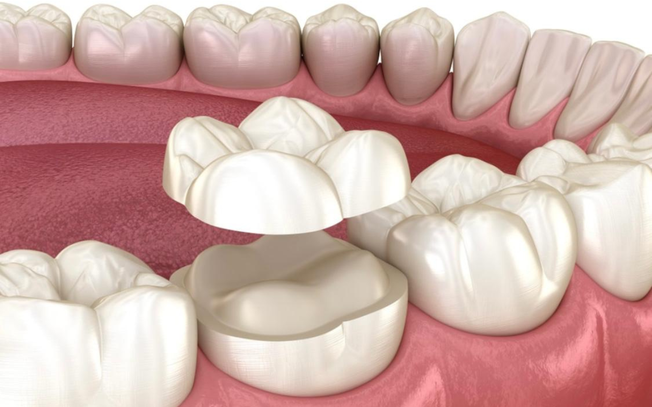 Restauração indireta confeccionada em laboratório pela Dra. Fabiola Roggia